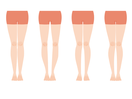 足の歪みの画像